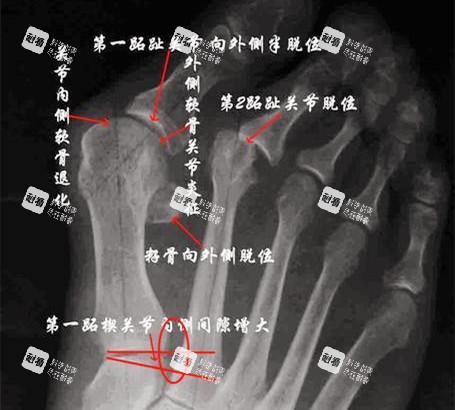 大腳骨X光片 大腳骨X光片