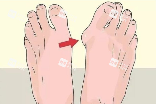 大腳骨整形前后對比圖 大腳骨整形前后對比圖