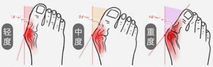 拇外翻大腳骨程度 拇外翻大腳骨程度