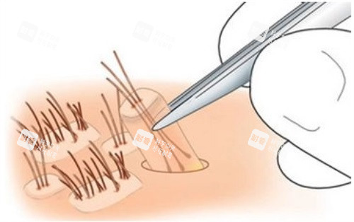 上班族植發(fā)日記：周末手術(shù)周一上班，無(wú)尷尬期無(wú)負(fù)擔(dān)，種頭發(fā)預(yù)約碧蓮盛，悄悄變好看