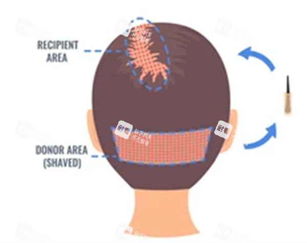 后枕毛囊移植過程圖解