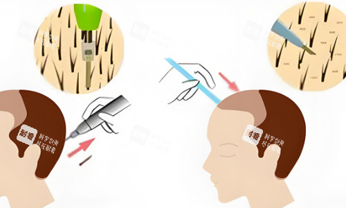 后枕部位取毛囊植發(fā)展示