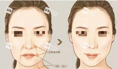 注射玻尿酸前后對比圖